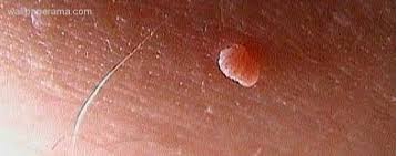 An arm lift, or brachioplasty, can tighten, lift and smooth the skin and tissues of your arm for a more sleek and sculpted shape. How To Remove Skin Tags On My Neck By Myself At Home