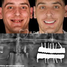 Image result for dental implant