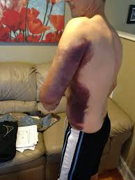 Image result for Fall on Shoulder