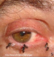 Image result for Demodex brevis