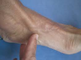 La ténosynovite est une inflammation du tendon et de la gaine tendineuse : Partie 2 Le Plan Anterieur La Medecine Du Sport