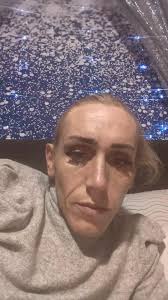 Jenna Shae Before Surgeey