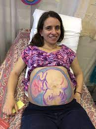 Breech presentation with longitudinal lie: Left Occiput Anterior Loa Spinning Babies
