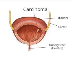Image result for Bladder Cancer Staging