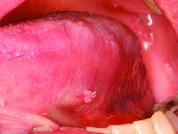 Image result for papillomavirus tongue)