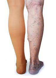 What Is The Purpose Of Compression Socks Complete Guide