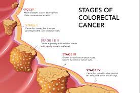 More adults in their 20s and 30s are being diagnosed. 10 Things You Should Know About Colorectal Cancer Health News Top Stories The Straits Times