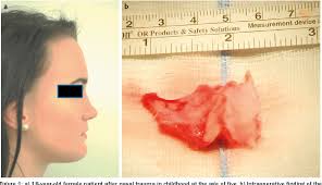 Pdf Diseases Of The Nose And Paranasal Sinuses In Child Semantic Scholar