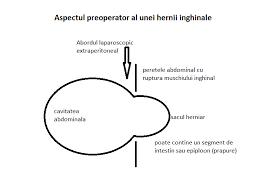 Senzatie de arsura sau durere in jurul proeminentei. Totul Despre Hernia Inghinala Cauze Simptome Si Tratament Corect Reginamaria Ro