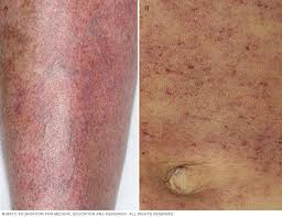 Los puntos rojos en la piel o manchas rojas pueden ser causados por una variedad de condiciones, incluyendo infecciones, reacciones alérgicas, y procesos inflamatorios. Petequias Middlesex Health