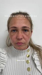 Life-Changing Pigmentation Removal Treatment