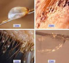 Comb your hair using lice or flea comb to remove any remaining nits. How To Remove Head Lice Eggs Lice Eggs Head Louse Louse