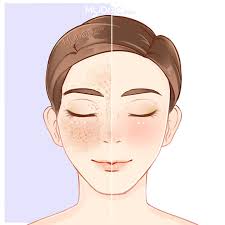 The american variant of the english language differs from british english in pronunciation, some minor features of grammar, spelling standards and vocabulary. Top 3 Melasma Treatment In Malacca Price Guide Reviews