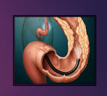 You should be passing gas. Fiberoptic Colonoscopy