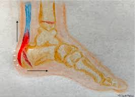Image result for Calcaneal Apophysitis