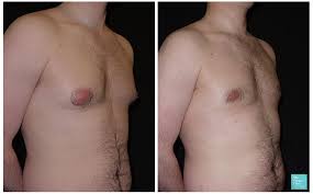 Top Gynecomastia Doctor Uk 2019 Board Certified Plastic Surgeon Gynecomastia Removal