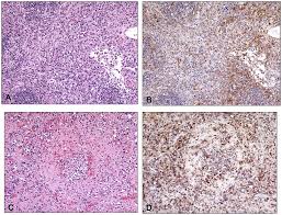 This is followed by a rash that forms blisters and crusts over. Plos One Susceptibility Of Marmosets Callithrix Jacchus To Monkeypox Virus A Low Dose Prospective Model For Monkeypox And Smallpox Disease