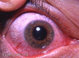 Image result for Eye Foreign Body