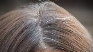 Bradford university researchers have found a cure for grey hair which is set to shake up the hair dye industry. Premature Gray Hair Medical Problems Find Home Remedies