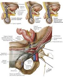 Many of the specific activities that set off the injury often times include a swift kicking motion, such as running or playing soccer or hockey. Open Inguinal Hernia Repair Basicmedical Key