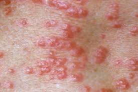 The skin is one of the largest organs in the body and communicates directly with both the external and internal. Scabies Pictures Of Rash Mites Symptoms Treatment
