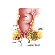 Image result for Perirectal Abscess