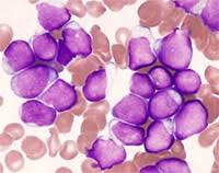 Folgende beschwerden können anzeichen einer leukämie sein: Leukemie Linkos Cz