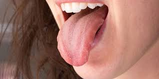 Image result for cancer of tongue