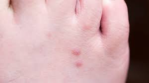 Image result for flea bites