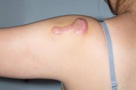 Steril ortamda profesyonel ile kişiye özel tek kullanımlık malzemeler ile. Keloid Scars Nhs