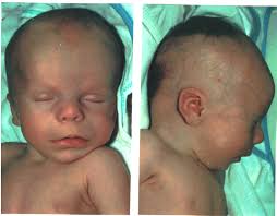 Pallister–Killian Syndrome versus Trisomy 12p—A Clinical Study of 5 New  Cases and a Literature Review