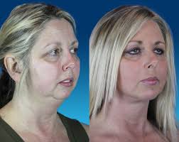 Pin On America Korea Plastic Plastic Surgery