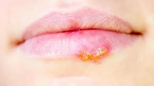 Sobald du das erste kribbeln und. Lippenherpes Ursachen Symptome Und Behandlung Der Infektion