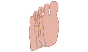 Neuromas Natural Footgear