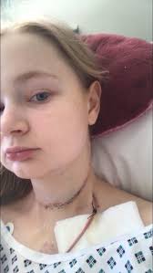 The lumps themselves are swollen lymph nodes, and they typically appear in the neck, armpit, or groin. Woman Left With 10 Inch Scar After Neck Lump From Braces Turns Out To Be Cancer Mirror Online