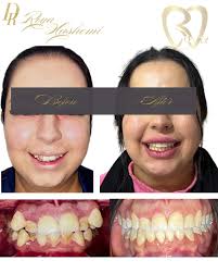 Severe dental crowding was corrected with fixed orthodontic treatment and  first premolar extractions. اصلاح بهم ريختگي شديد دندانها با كشيدن ٤ دندان.  ✍🏻قشنگترين حس دنياست وقتي تو زيباتر ميخندي😍. #بخند #زيباتر #