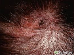 Usually, once the scalp ringworm has subsided, hair begins to grow back as normal. Ringworm Tinea Capitis Close Up Medlineplus Medical Encyclopedia Image