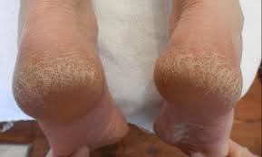 Maizena es gibt eine ganze reihe von hausmittel, die effektiv rissige hornhaut entfernen. Nervt Dich Deine Eingerissene Hornhaut Auch So Sehr Dann Verwende Diese Naturlichen Mittel Und Du Bist Sie Im Nu Los