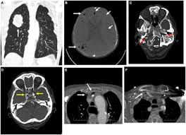 Image result for Progressive Bulbar Paralysis