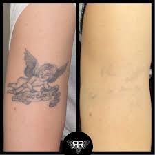There are several variables that affect how many treatments are required for complete removal and all tattoos are different. How Many Sessions To Remove Tattoo Arxiusarquitectura