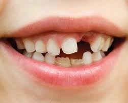 Kidzaid Australia Dental Injury Kidzaid Australia