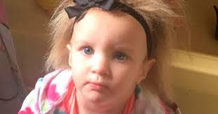 Toddler's rare 'permanent bedhead' leaves her in agony every morning