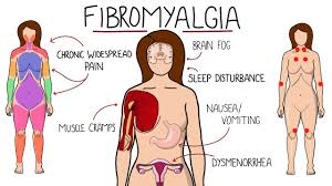 Image result for Fibromyalgia