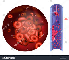 Image result for Hypercoagulable