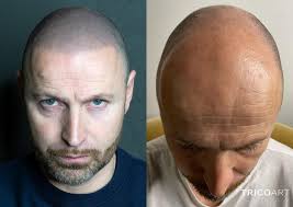 Tricopigmentazione a Siena