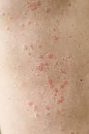 Maybe you would like to learn more about one of these? Infeccia N Cuta Nea Alergia Cuta Nea Urticaria Manchas Rojas En La Piel Foto De Archivo Imagen De Imagen Levantado 158917846
