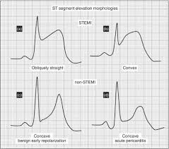 Image result for ST Elevation