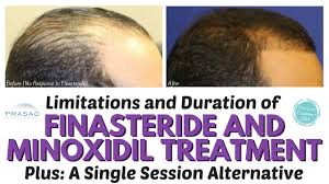 In addition to stimulating hair growth and quelling a receding one myth that surrounds the use of minoxidil is that it eventually worsens hair loss when stopped. Minoxidil Rogaine Proper Use Limitations Side Effects Ny Hair Loss