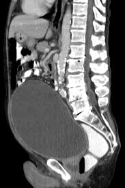 Urinary Retention Wikipedia