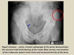 Presentation1 Pptx Radiological Imaging Of Metabolic Bone Diseases